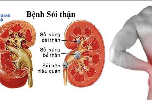 10 cách giúp bạn phòng ngừa sỏi thận