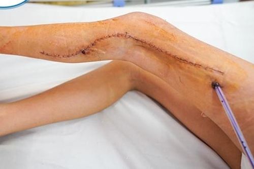 Ca phẫu thuật thần kì cứu bé gái khỏi bị cưa chân