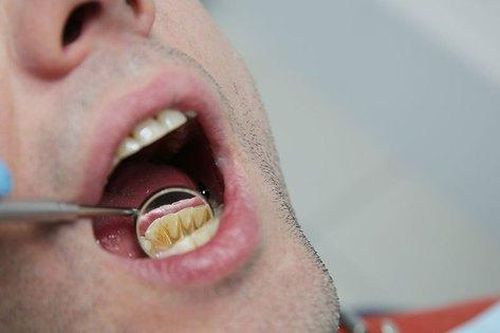 4 cách loại bỏ cao răng tại nhà