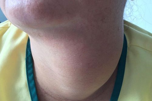 Nữ bệnh nhân được phẫu thuật bóc tách bướu cổ nặng gần 1kg