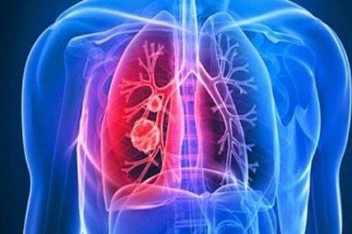 Thuốc trị ung thư, triển vọng trong điều trị xơ phổi vô căn