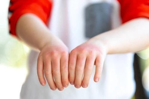 Thuốc điều trị chàm cho bệnh nhi dưới 6 tuổi