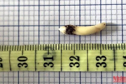 Phẫu thuật gắp răng dài 2cm mọc ngược vào hốc mũi