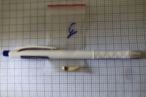 Hiếm có: Răng thừa dài 2cm mọc ngược trong hốc mũi cô gái