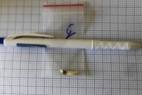 Cô gái trẻ đau đầu nhiều năm, đi khám phát hiện có 2 chiếc răng dài 2 cm mọc ngược trong hốc mũi