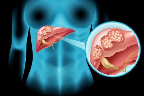 Dự báo tỷ lệ ung thư gan tăng cao vào năm 2040