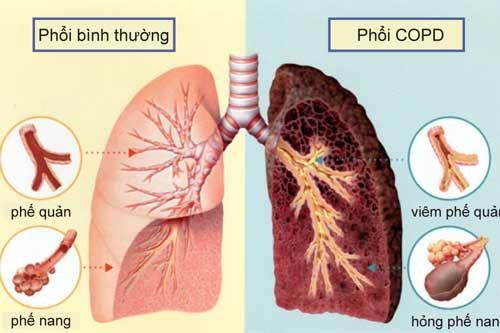 Thói quen quá phổ biến không ngờ khiến ung thư ở Việt Nam tăng không kiểm soát