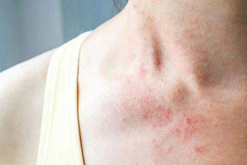 Xử lý thế nào khi da bị mẩn ngứa trong mùa hè