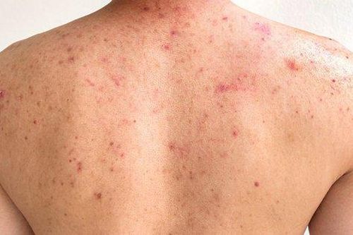 Thuốc điều trị gây mụn trứng cá, có nên ngừng dùng?