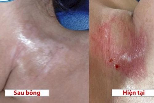 Cảnh báo bỏng hóa chất từ dầu mỡ