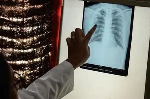 Lao tiếp tục là căn bệnh truyền nhiễm gây tử vong hàng đầu trên thế giới