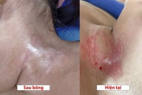 Cảnh báo bỏng hóa chất từ chất tẩy dầu mỡ