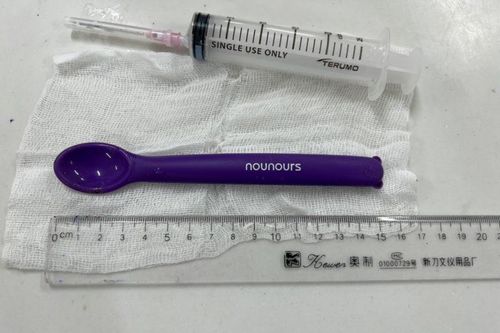 Cô gái 20 tuổi nuốt luôn thìa nhựa 15cm vào bụng