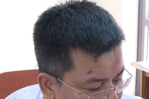 Khởi tố, bắt tạm giam đối tượng dúi thuốc lá đang cháy vào mặt Công an