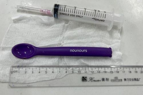 Cô gái say rượu rồi nuốt chiếc thìa nhựa dài 15cm vào bụng