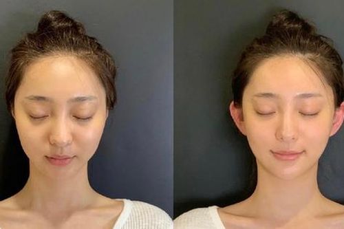 Bình luận trái chiều về trào lưu thẩm mỹ 'tai yêu tinh'