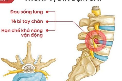 Dr.Allen Chiropractic - chữa thoát vị đĩa đệm bằng phương pháp bảo tồn không phẫu thuật