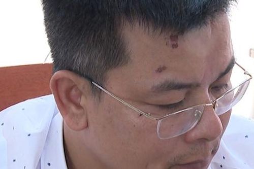 Khởi tố đối tượng lăng mạ, dùng điếu thuốc lá đang cháy dúi vào mặt một cán bộ công an