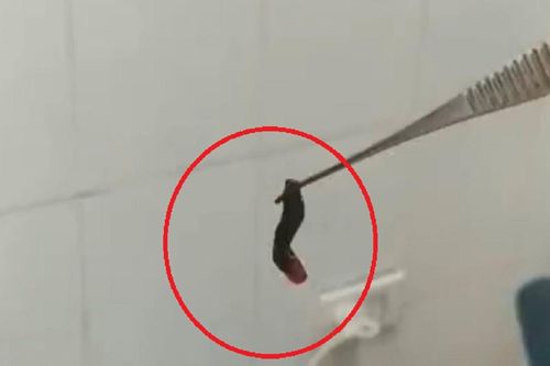 Đi khám vì thường xuyên chảy máu cam, tá hỏa phát hiện con vắt sống trong hốc mũi