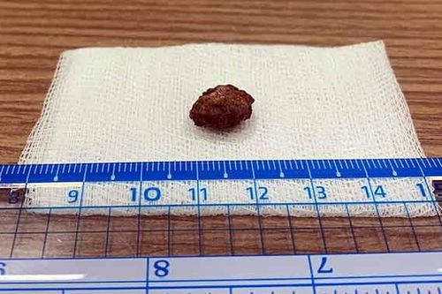 Viên sỏi to bằng viên bi trong hốc mũi nam thanh niên