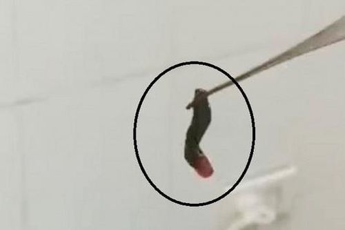 Quảng Ninh: Chảy máu cam, đi khám phát hiện con vắt dài 2cm trong mũi