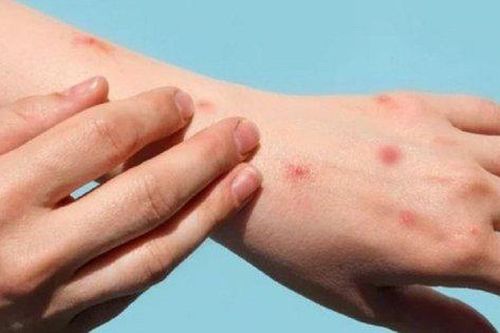 Nhiễm HIV và nguy cơ mắc bệnh đậu mùa khỉ trầm trọng