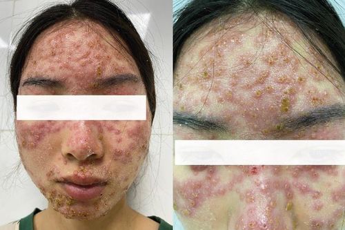 Mặt nổi nhiều mụn vì đắp mặt nạ 'detox' tại spa