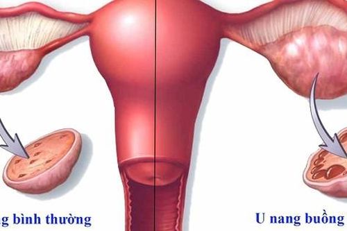 U buồng trứng khi mang thai