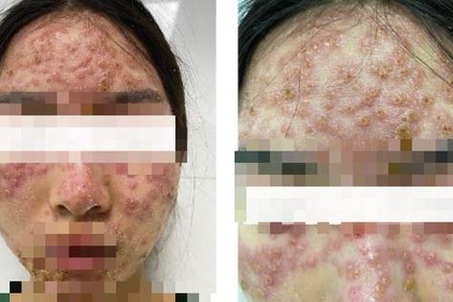 Mặt loang lổ mụn nước sau khi đắp mặt nạ detox chữa trứng cá