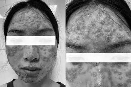 'Detox' da tại spa, cô gái bị bội nhiễm da Eczema herpeticum