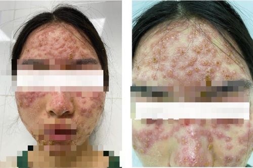 Đắp mặt nạ detox chữa trứng cá tại spa, cô gái bị tổn thương da phải nhập viện