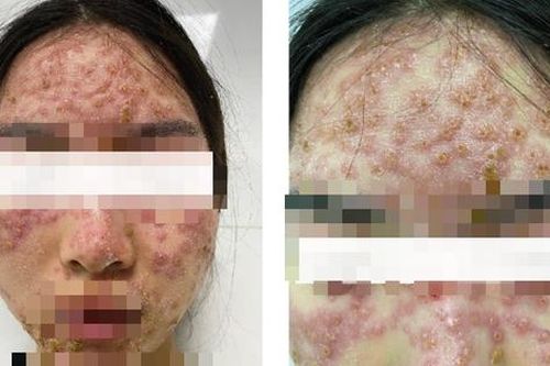 Cô gái trẻ cấp cứu vì nhiễm trùng nặng sau khi detox trị mụn, bác sĩ cảnh báo tình trạng hoại tử, thậm chí mất mạng vì lý do này