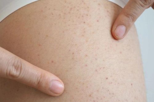 Cô gái 19 tuổi mắc chứng rối loạn máu hiếm gặp sau khi nổi ban đỏ