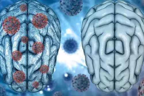 Covid-19 có thể gây viêm não tương tự bệnh Parkinson