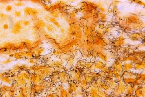 Các chuyên gia cảnh báo dịch bệnh lây nhiễm qua đường tình dục ở Mỹ đang ngoài tầm kiểm soát