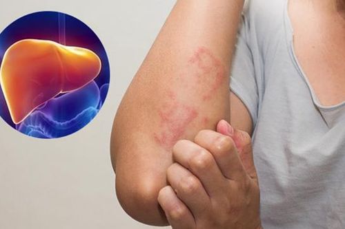 Cảnh báo 6 dấu hiệu gan nhiễm độc cần đi khám ngay