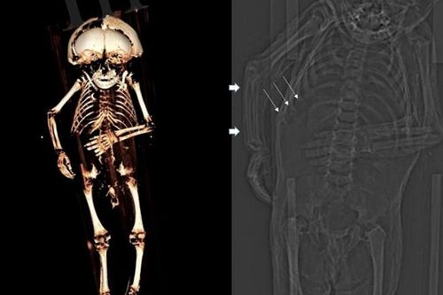 Nóng: Giải mã thành công xác ướp bé trai chôn cách đây 400 năm