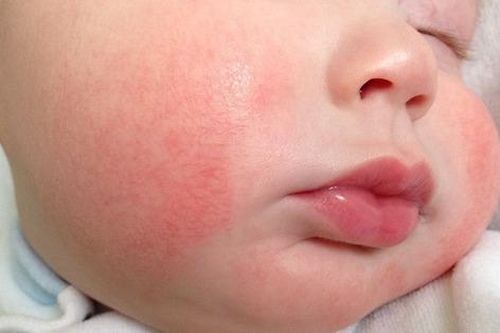 Nguyên nhân và cách chăm sóc trẻ bị ngứa mẩn đỏ vào mùa đông