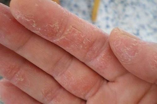 Nhận biết nguyên nhân và đề phòng bệnh á sừng tái phát