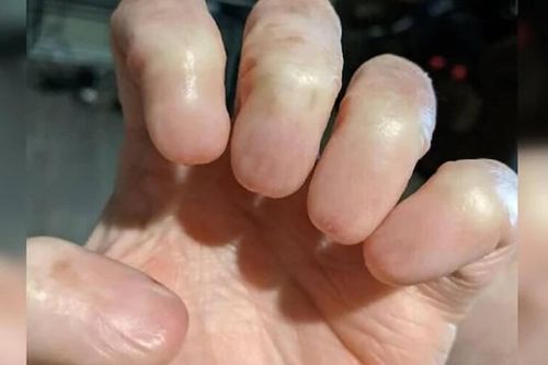 'Dị nhân' không có móng tay, không dấu vân tay