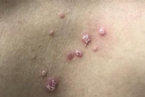 Bé trai hơn 1 tuổi bất ngờ được phát hiện mắc 'bệnh người lớn'
