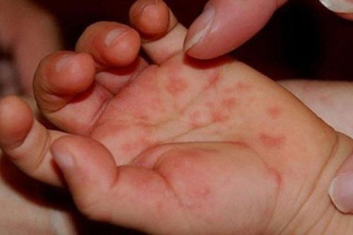 Bất ngờ bé trai 18 tháng tuổi mắc giang mai