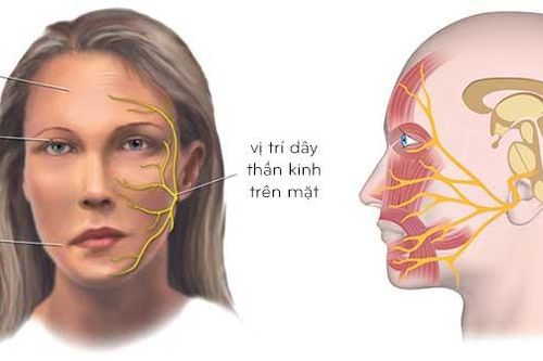 Người phụ nữ méo miệng, mất cảm giác nửa mặt sau một giấc ngủ
