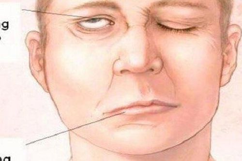 Tá hỏa vì liệt một bên mặt sau khi ngủ dậy