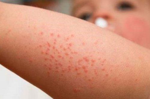 Biến chứng của sởi và cách phòng tránh