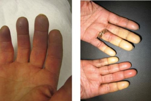 Kỳ lạ: Người phụ nữ có ngón tay 'đổi màu' liên tục theo thời tiết, cảm xúc