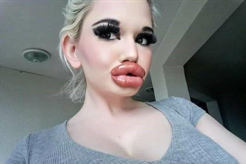 Dù nguy hiểm đến tính mạng, cô gái vẫn tiêm filler môi 32 lần