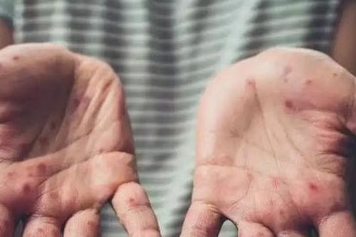Bộ Y tế xếp bệnh đậu mùa khỉ vào nhóm B