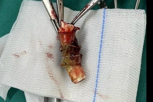 Cứu bệnh nhân bị tắc nghẽn đường thở do đoạn canuyn rơi vào khí quản