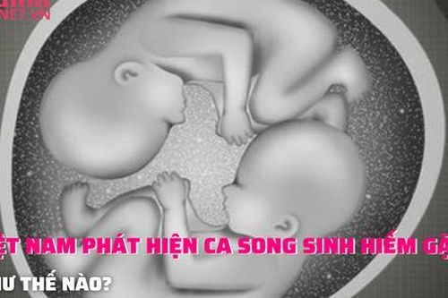 Việt Nam ghi nhận ca song thai hiếm thứ hai trên thế giới như thế nào?